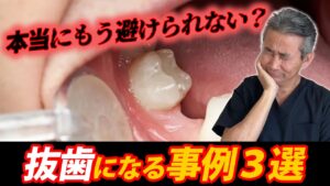 本当にもう避けられない？抜歯になるケース３選
