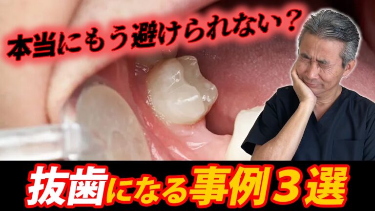 本当にもう避けられない？抜歯になるケース３選